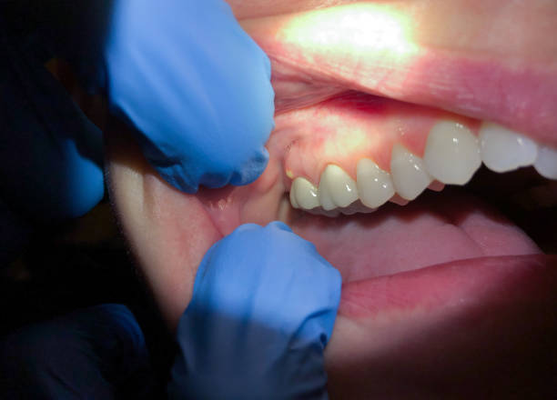 Best Emergency Dentist for Lost Fillings or Crowns in China Spring, TX
